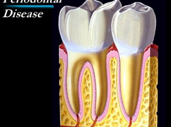periodontal1